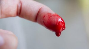Top 6 Cách cầm máu tại nhà với vết thương nhẹ hiệu quả nhất