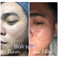 Top 2 Spa trị sẹo rỗ do mụn uy tín nhất tại TP. Vinh, Nghệ An