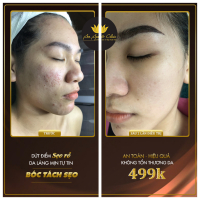 Top 3 Spa trị sẹo rỗ do mụn uy tín nhất tại Cần Thơ