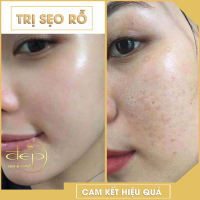 Top 3 Spa trị sẹo rỗ do mụn uy tín nhất tại Nha Trang