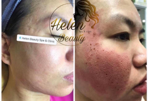 Top 3 Spa trị sẹo rỗ do mụn uy tín nhất tại Vũng Tàu