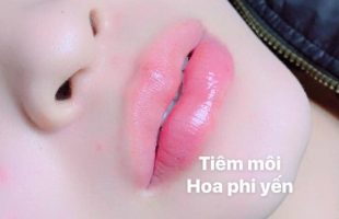 Top 5 Địa chỉ tiêm filler – botox uy tín và chất lượng nhất Vũng Tàu